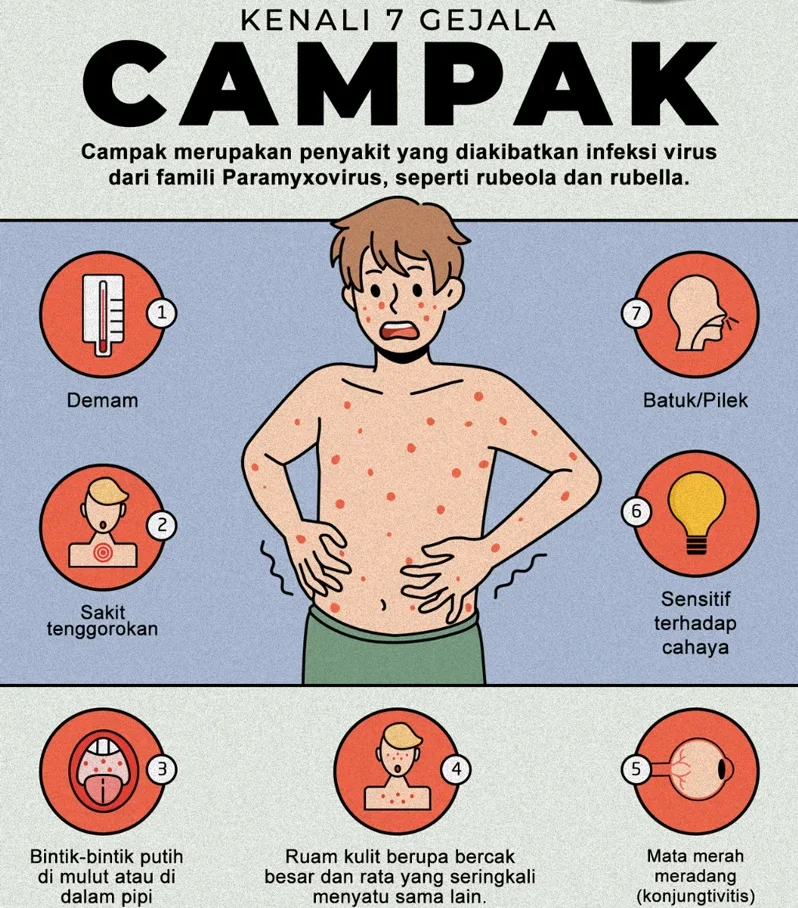 Waspada Gejala Campak, Kenali Ciri-cirinya Sebelum Terlambat agar Tak Menular ke Keluarga