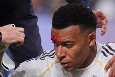 Pelipis Pecah, Mbappe Absen Jelang Laga Penting di Champions League vs Munchen?