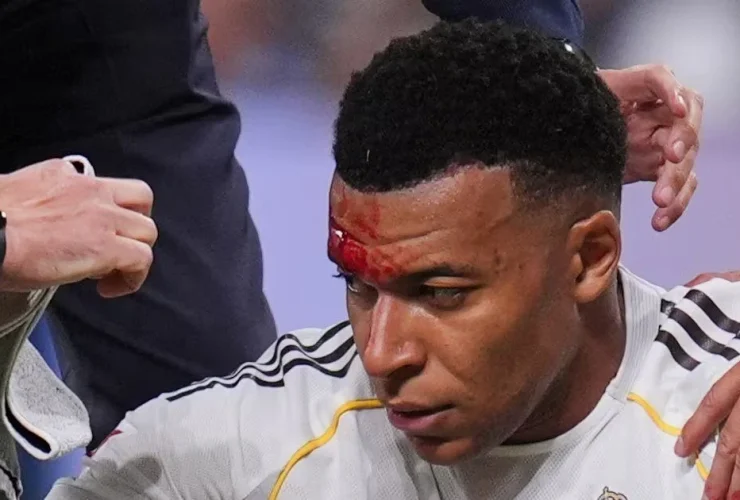 Pelipis Pecah, Mbappe Absen Jelang Laga Penting di Champions League vs Munchen?